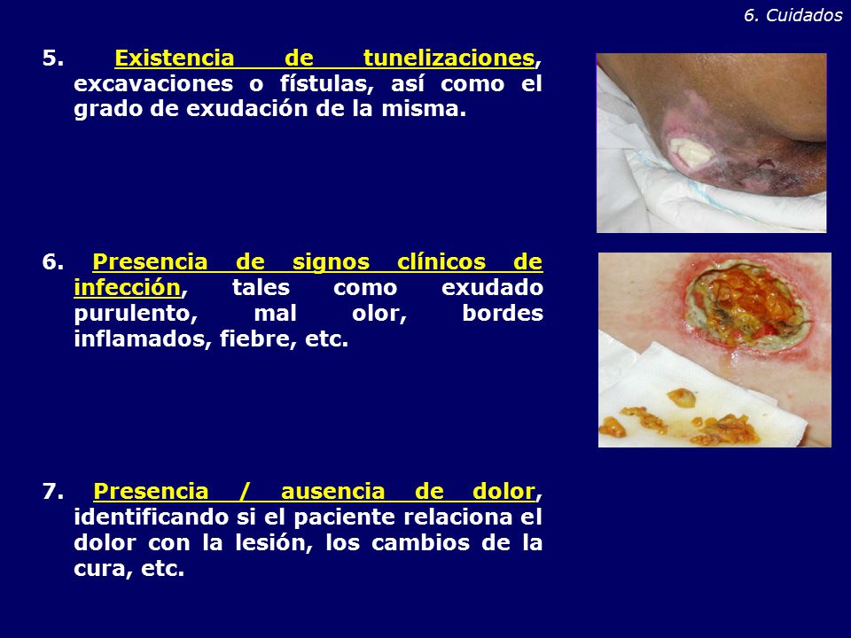 6. Cuidados 5. Existencia de tunelizaciones, excavaciones o fístulas, así como el grado de exudación de la misma.