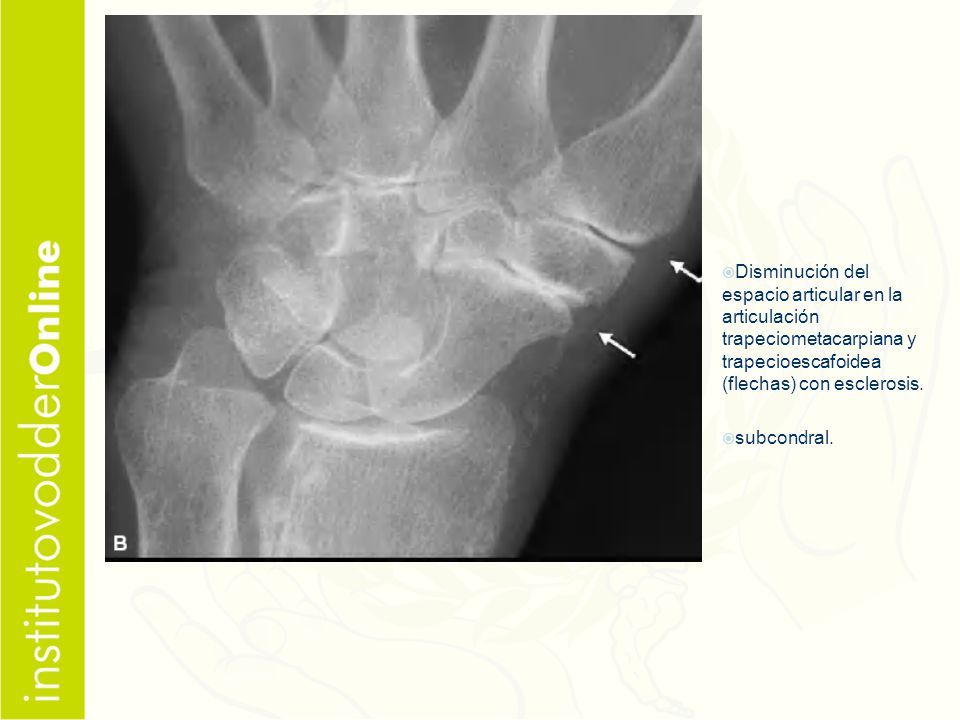 Disminución del espacio articular en la articulación trapeciometacarpiana y trapecioescafoidea (flechas) con esclerosis.