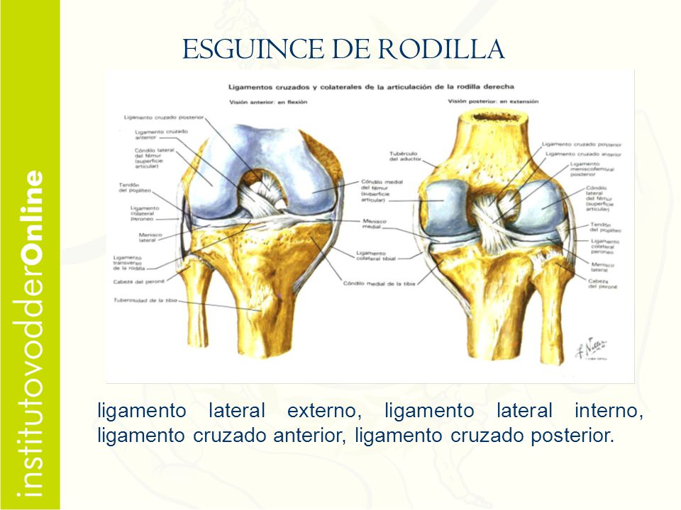 ESGUINCE DE RODILLA ligamento lateral externo, ligamento lateral interno, ligamento cruzado anterior, ligamento cruzado posterior.