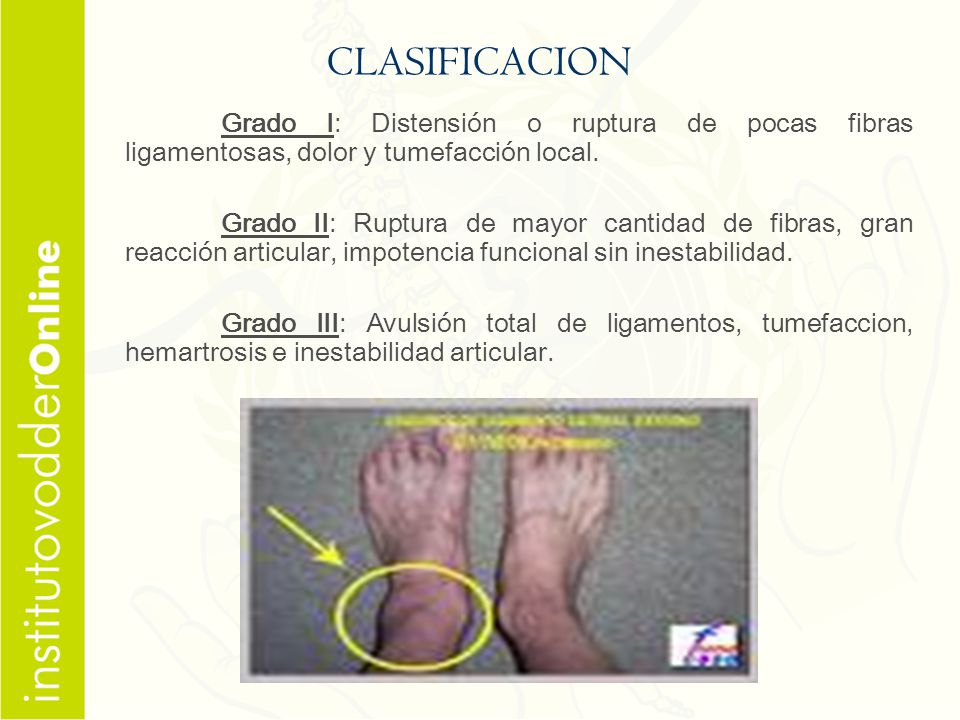CLASIFICACION Grado I: Distensión o ruptura de pocas fibras ligamentosas, dolor y tumefacción local.