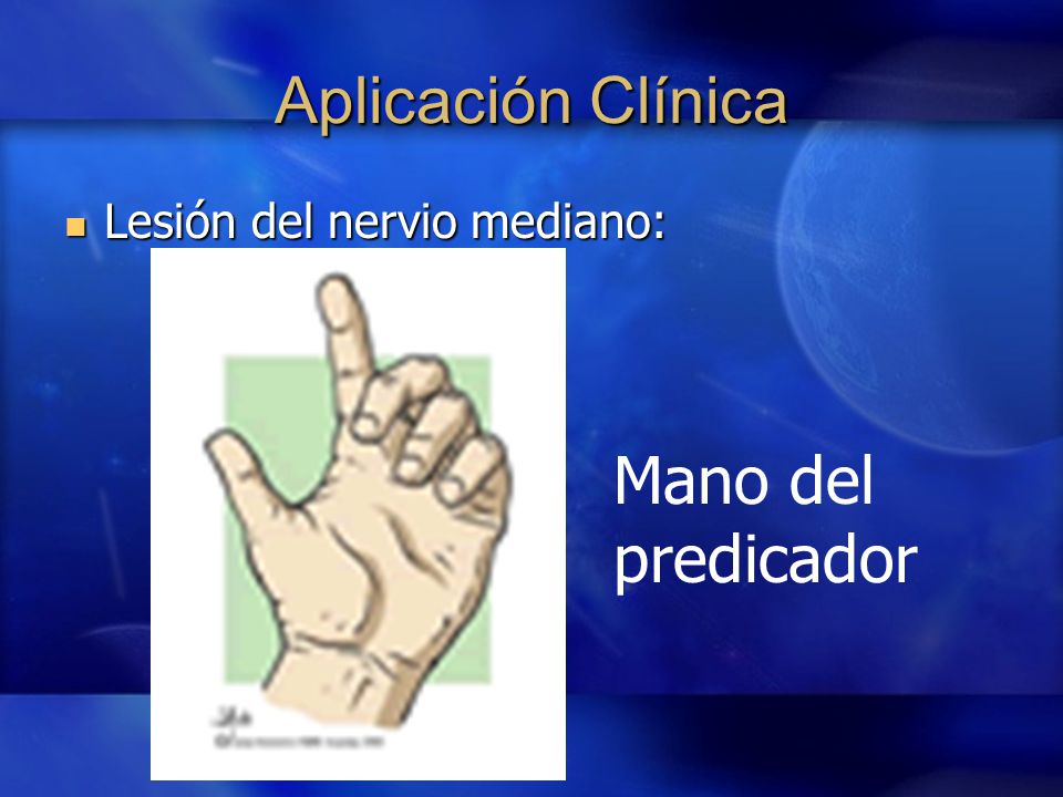 Aplicación Clínica Lesión del nervio mediano: Mano del predicador