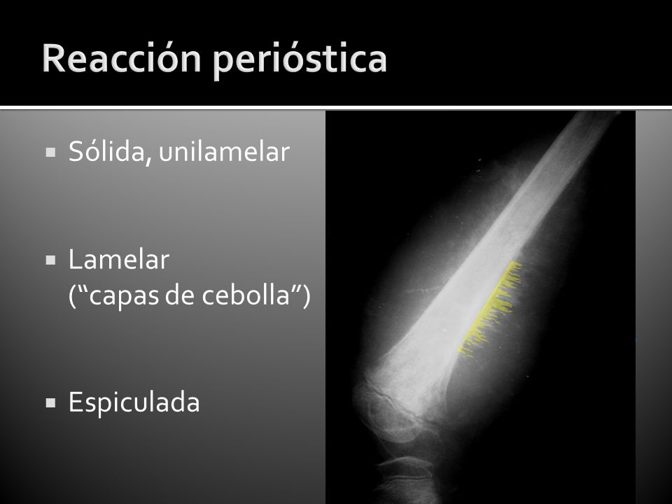 Reacción perióstica Sólida, unilamelar Lamelar ( capas de cebolla )