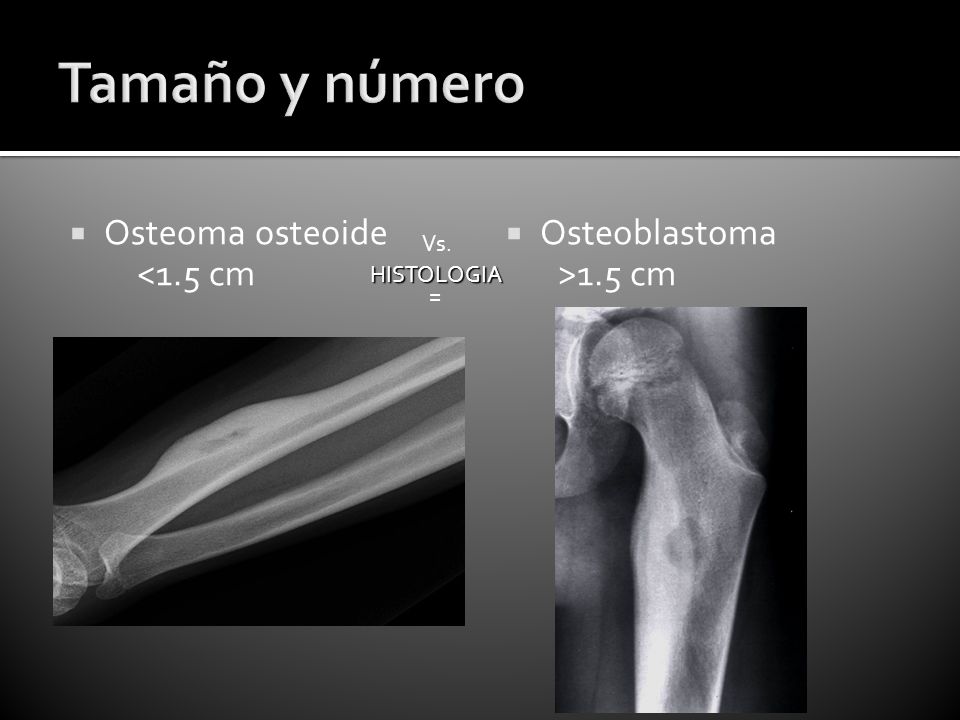 Tamaño y número Osteoma osteoide <1.5 cm Osteoblastoma >1.5 cm