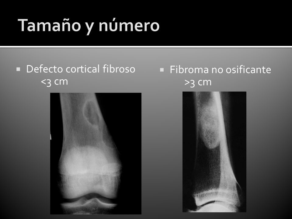 Tamaño y número Defecto cortical fibroso Fibroma no osificante
