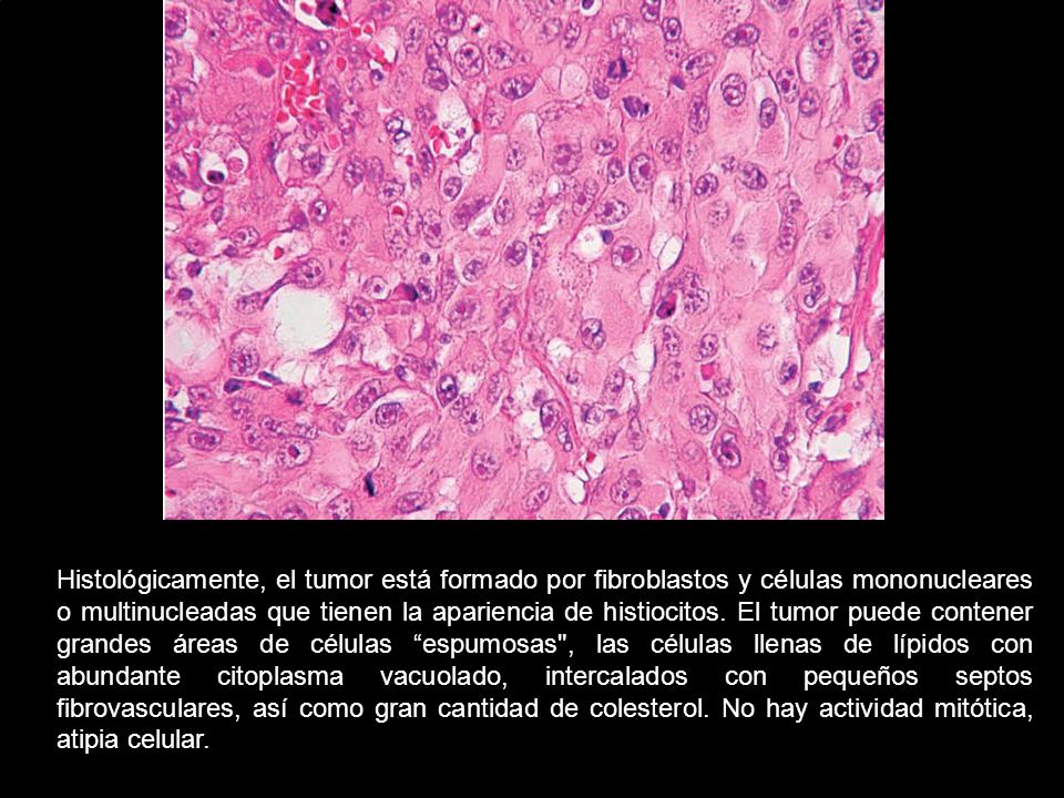 Histológicamente, el tumor está formado por fibroblastos y células mononucleares o multinucleadas que tienen la apariencia de histiocitos.