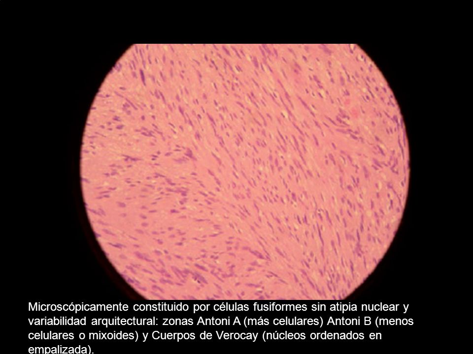 Microscópicamente constituido por células fusiformes sin atipia nuclear y variabilidad arquitectural: zonas Antoni A (más celulares) Antoni B (menos celulares o mixoides) y Cuerpos de Verocay (núcleos ordenados en empalizada).