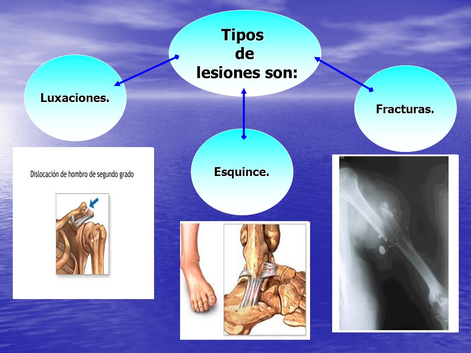 Tipos de lesiones son: Luxaciones. Fracturas. Esquince.