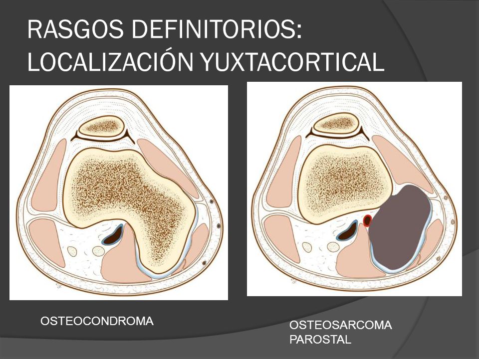 RASGOS DEFINITORIOS: LOCALIZACIÓN YUXTACORTICAL