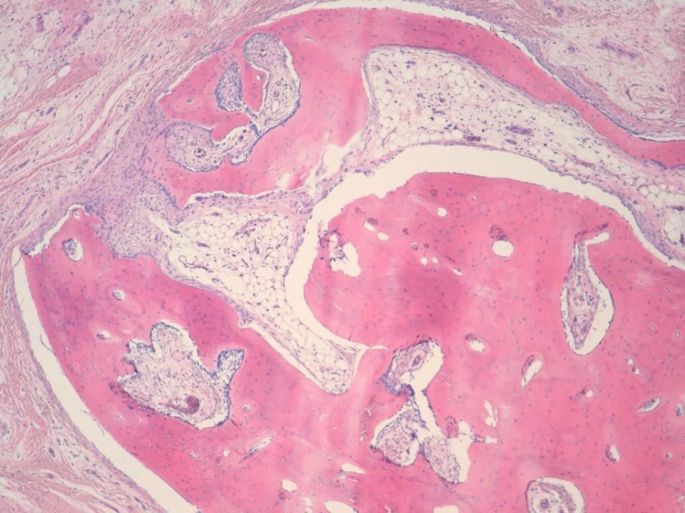 Microscópicamente esas lobulaciones se traducen en proyecciones digitiformes que no parecen infiltrar tejidos blandos perilesionales, y que muestran un centro de hueso compacto, con el estroma fibrolaxo, adiposo, de celularidad mayor en la periferia, que ya veíamos en la BAG