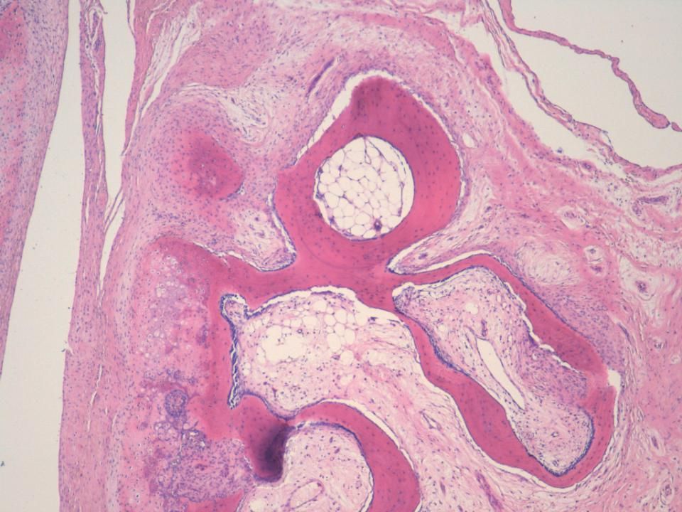 Si nos fijamos vemos que hay varias capas: una membrana fusocelular no muy grusea, a partir de la cual se forma cartílago y osteoide con núcleos hipercromáticos que forman trabéculas oseas con un prominente ribete osteoblastico y un conectivo laxo sin atipia llamativa.