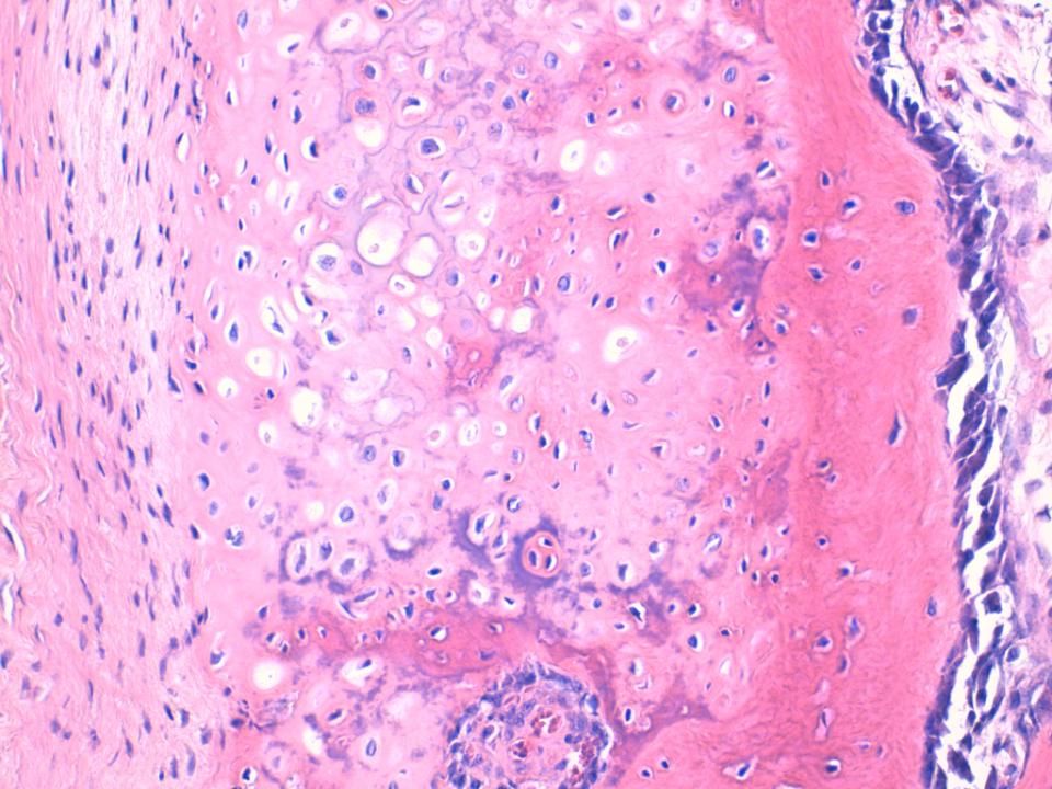La porción cartilaginosa presenta areas de moderada /alta celularidad,condrocitos de atipia moderada y nucleos regordetes., arquitectura desorganizada, a diferencia por ejemplo del osteocondroma conde la osificación del cartilago se parece a la fisiológica del cartílago de crecimiento, con disposición en columnas.