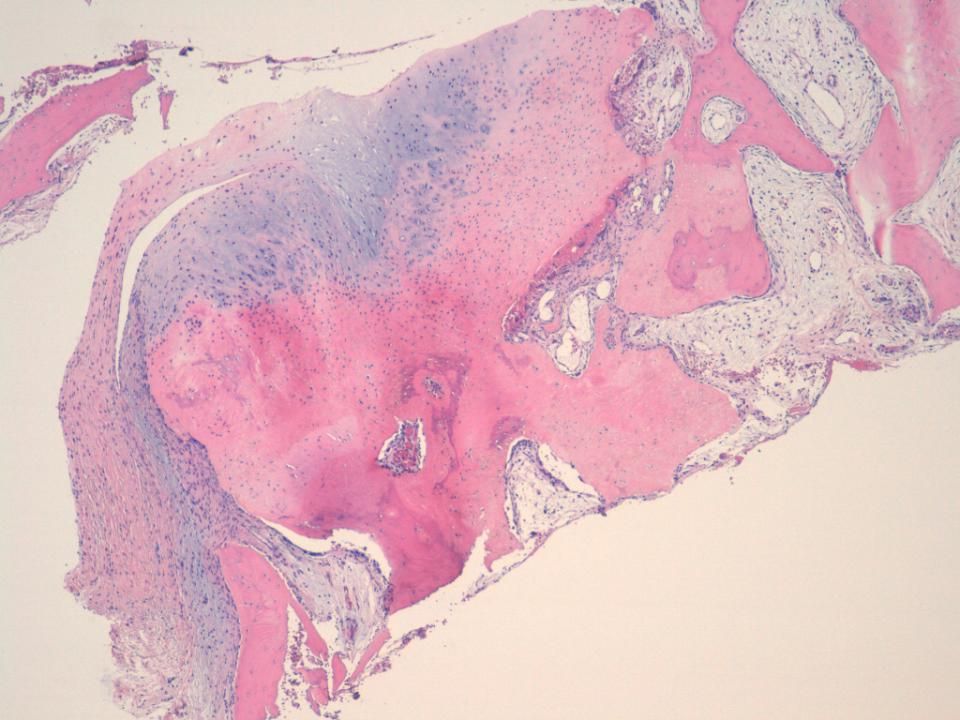 Cilindro de 1,5 cm.Se ven trabéculas muy gruesas de hueso con nucleos hipercromáticos inmersos en tejido conectivo moderadamente celular con atipia leve y a veces diferenciación condral.