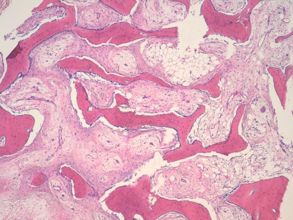 Trabeculas onduladas de hueso bien diferenciado entre las que se dispone un estroma fibroso, entre leve y moderadamente celular, sin atipias ni mitosis, con zonas de tejido adiposo.
