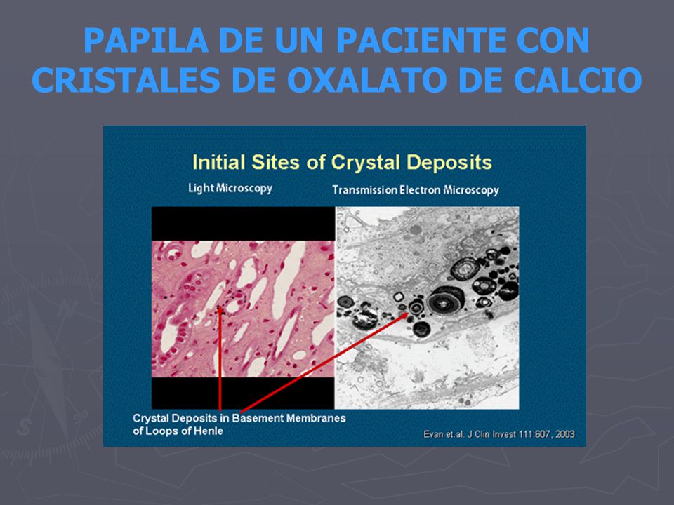 PAPILA DE UN PACIENTE CON CRISTALES DE OXALATO DE CALCIO