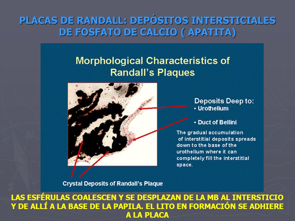 PLACAS DE RANDALL: DEPÓSITOS INTERSTICIALES DE FOSFATO DE CALCIO ( APATITA)