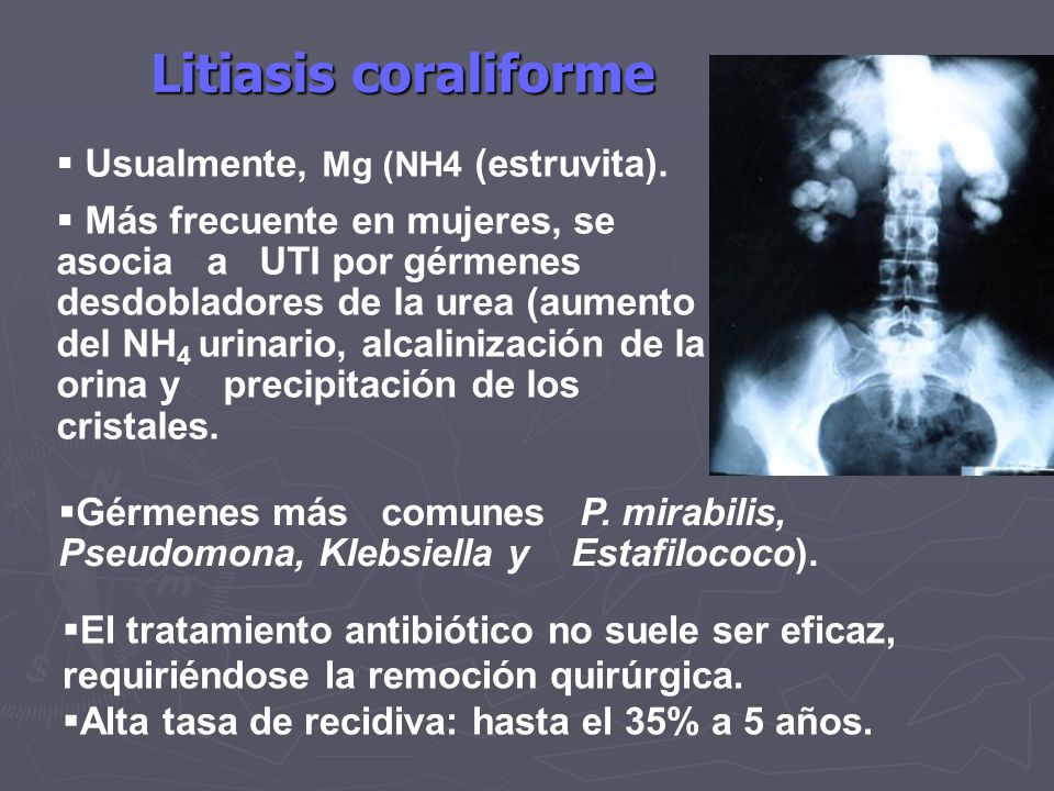 Litiasis coraliforme Usualmente, Mg (NH4 (estruvita).