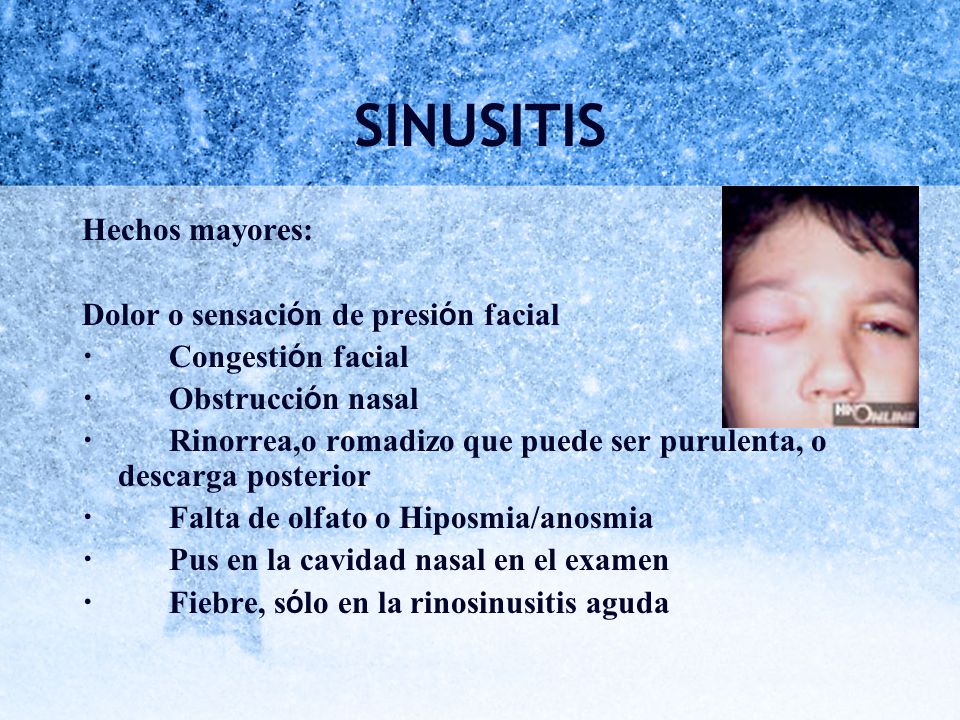 SINUSITIS Hechos mayores: Dolor o sensación de presión facial