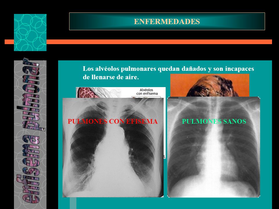 enfisema pulmonar ENFERMEDADES