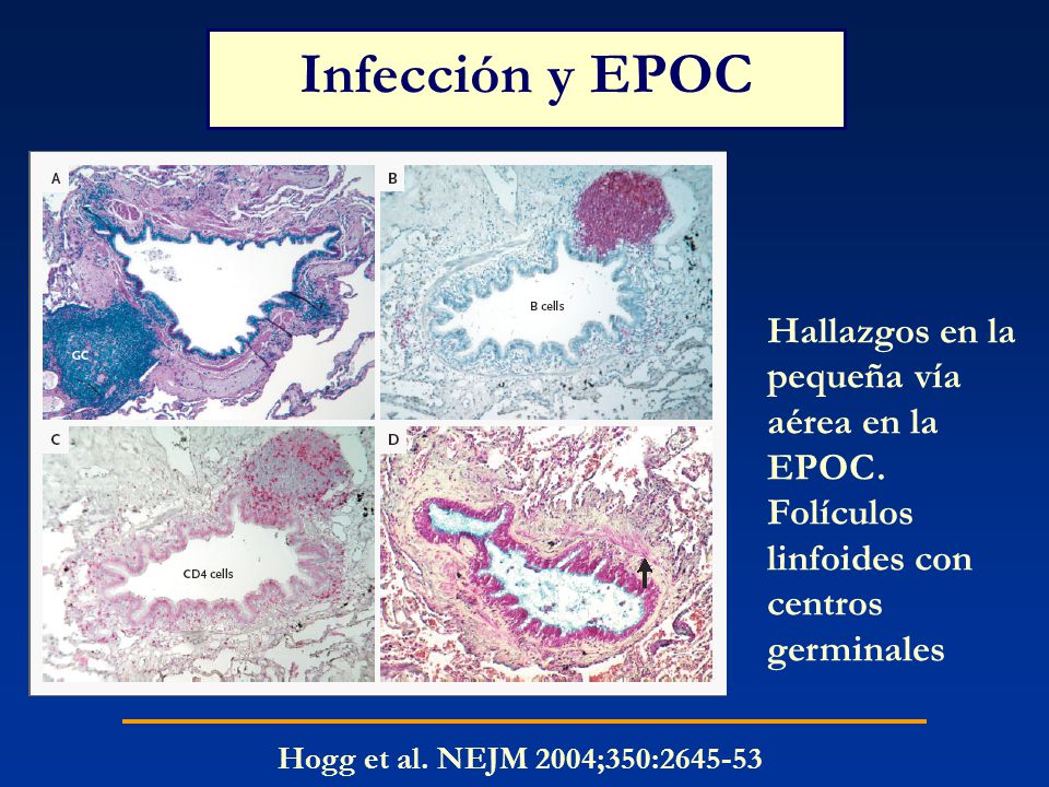 Infección y EPOC Hallazgos en la pequeña vía aérea en la EPOC. Folículos linfoides con centros germinales.
