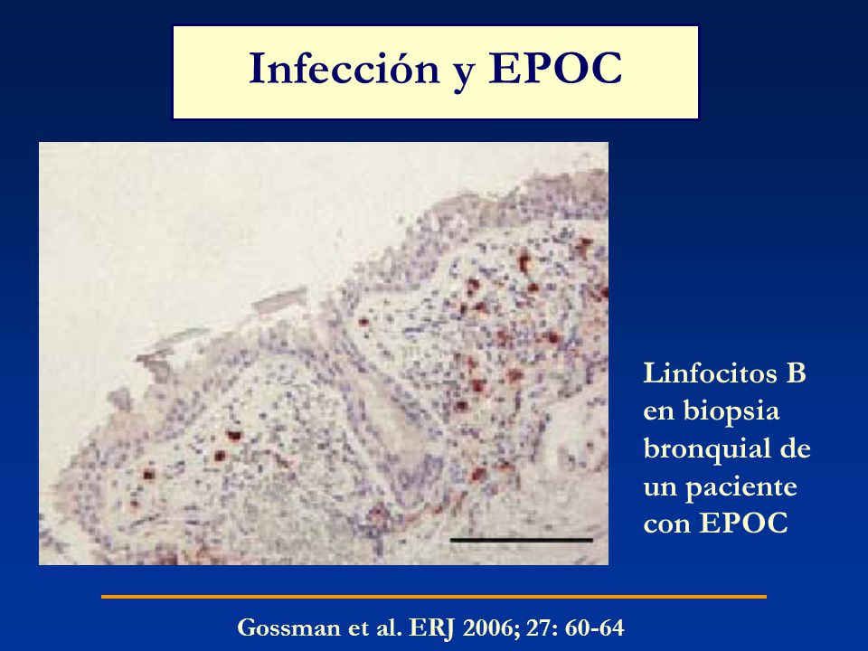 Infección y EPOC Linfocitos B en biopsia bronquial de un paciente con EPOC.