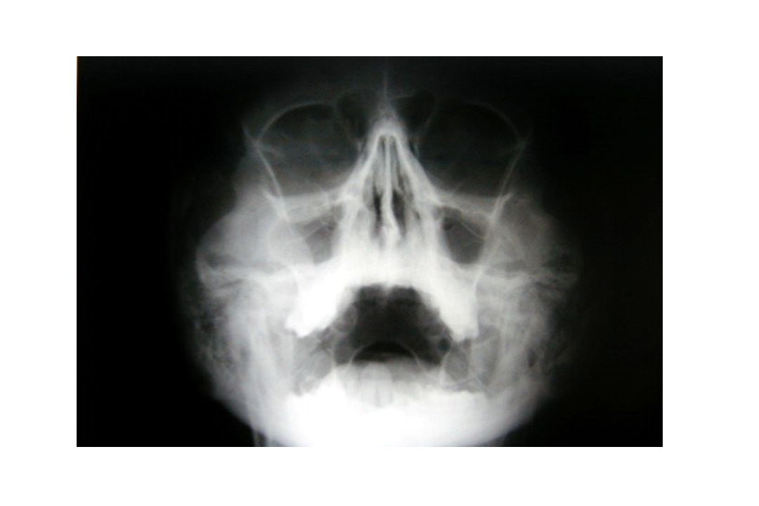 Aquí puede observarse una Radiografía de senos paranasales con veladura de seno maxilar derecho y edema de la mucosa del izquierdo.