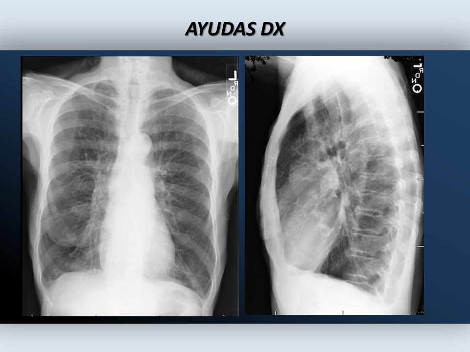 AYUDAS DX Ojo: El diagnostico de EPOC no se hace por radiografia.