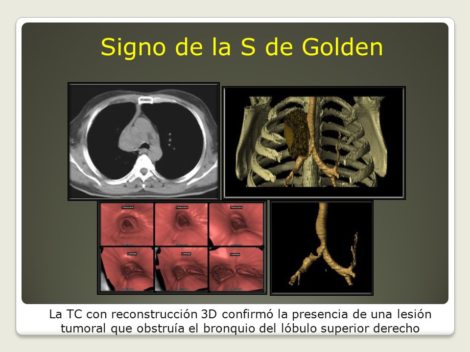 Signo de la S de Golden La TC con reconstrucción 3D confirmó la presencia de una lesión tumoral que obstruía el bronquio del lóbulo superior derecho.