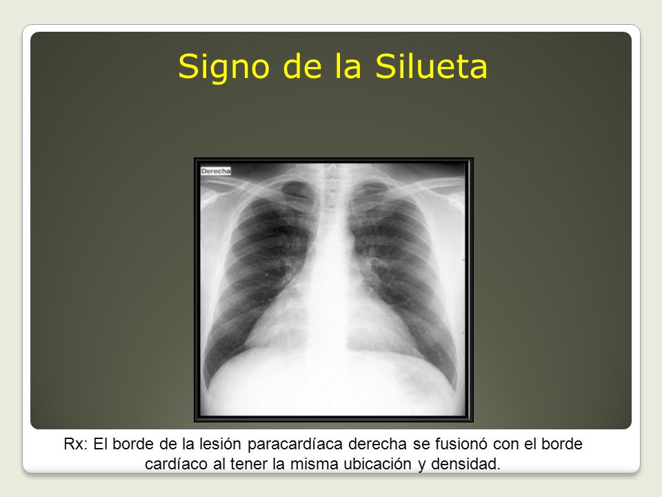 Signo de la Silueta Rx: El borde de la lesión paracardíaca derecha se fusionó con el borde cardíaco al tener la misma ubicación y densidad.