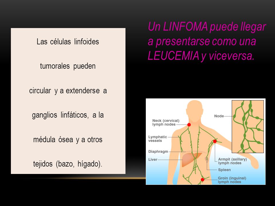Un LINFOMA puede llegar a presentarse como una LEUCEMIA y viceversa.