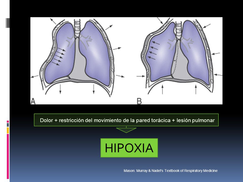Dolor + restricción del movimiento de la pared torácica + lesión pulmonar