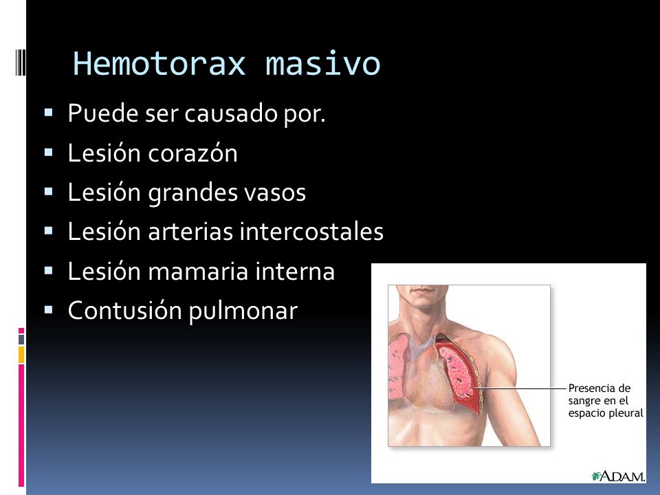 Hemotorax masivo Puede ser causado por. Lesión corazón