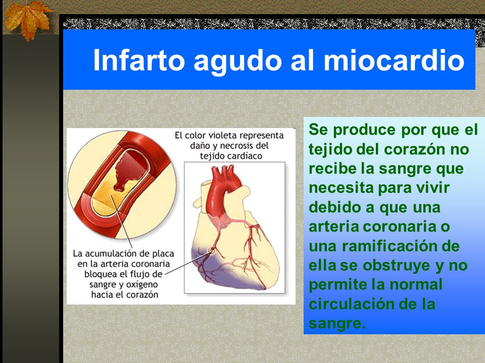 Infarto agudo al miocardio