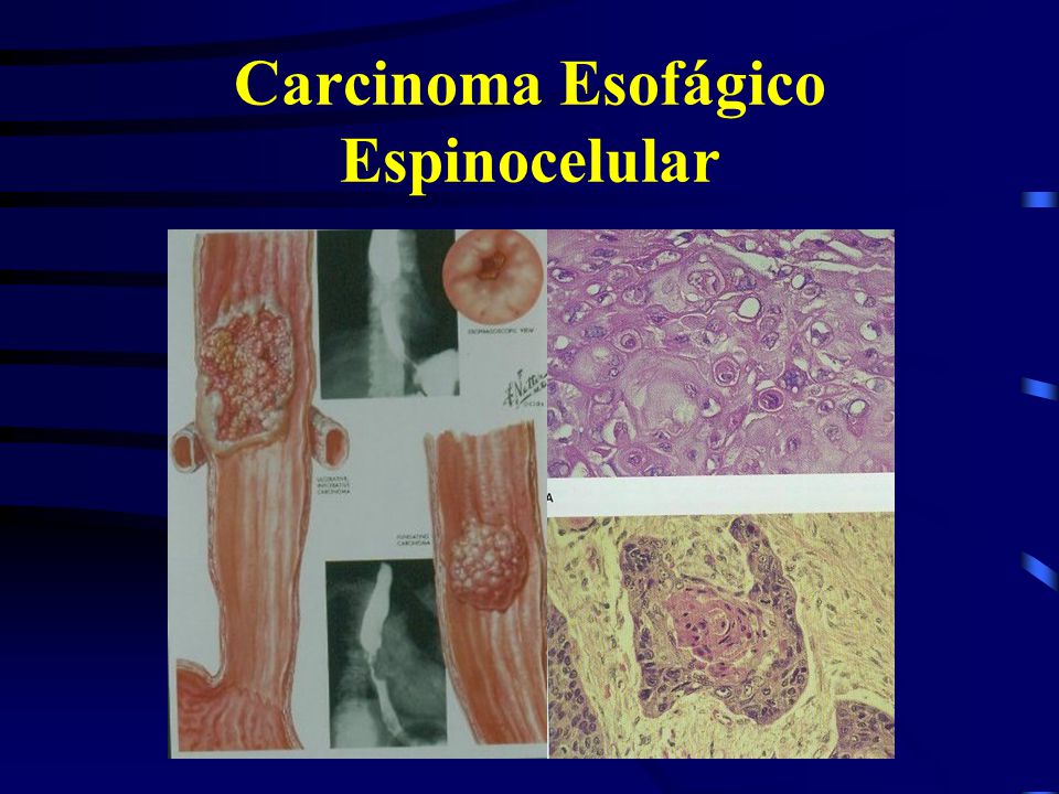 Carcinoma Esofágico Espinocelular