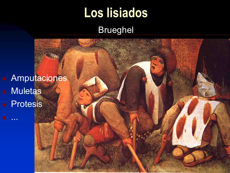 Los lisiados Brueghel Amputaciones Muletas Protesis ...