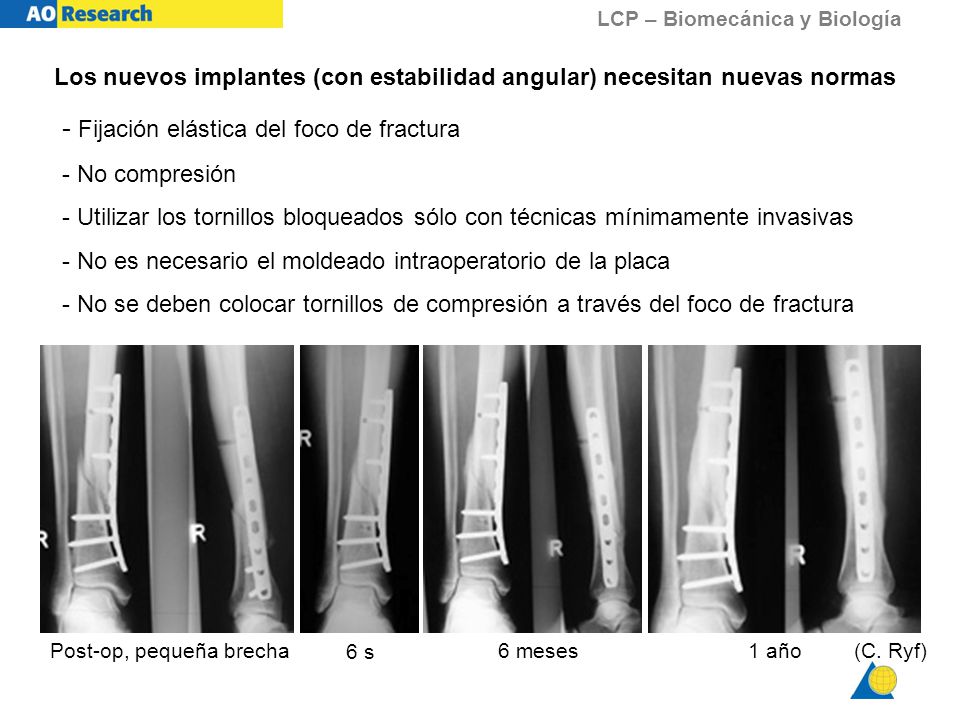 Los nuevos implantes (con estabilidad angular) necesitan nuevas normas
