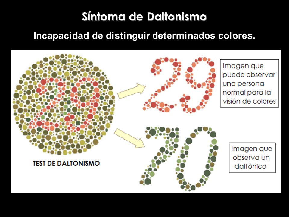 Incapacidad de distinguir determinados colores.