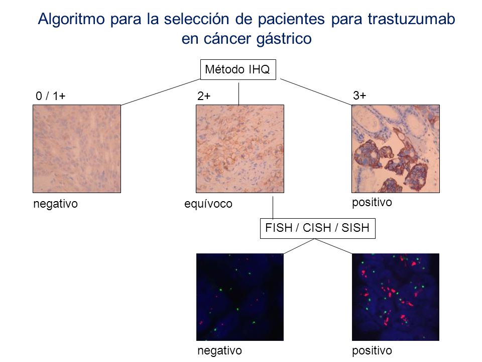 Algoritmo para la selección de pacientes para trastuzumab en cáncer gástrico