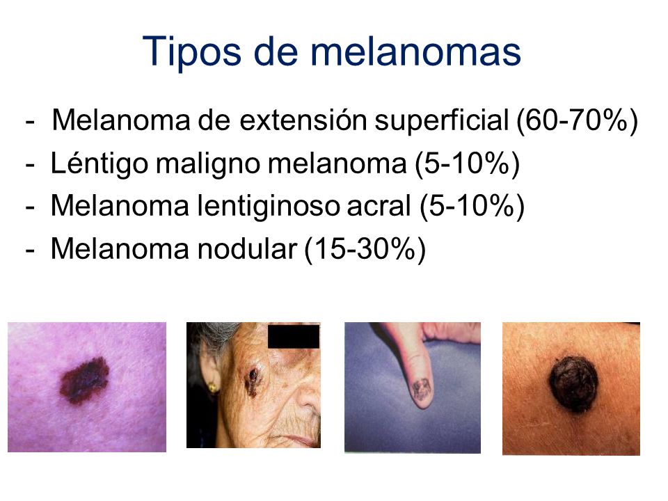 Tipos de melanomas - Melanoma de extensión superficial (60-70%)