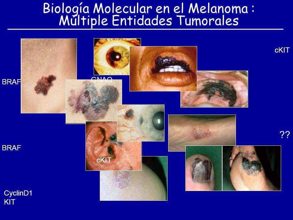 Biología Molecular en el Melanoma : Múltiple Entidades Tumorales