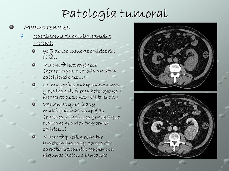 Patología tumoral Masas renales: Carcinoma de células renales (CCR):