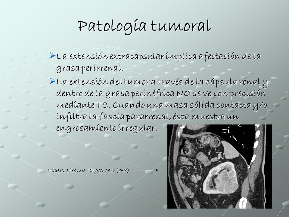 Patología tumoral La extensión extracapsular implica afectación de la grasa perirrenal.