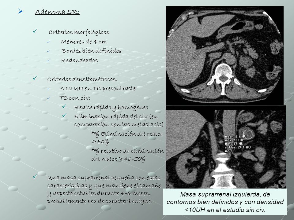 Adenoma SR: Criterios morfológicos Menores de 4 cm