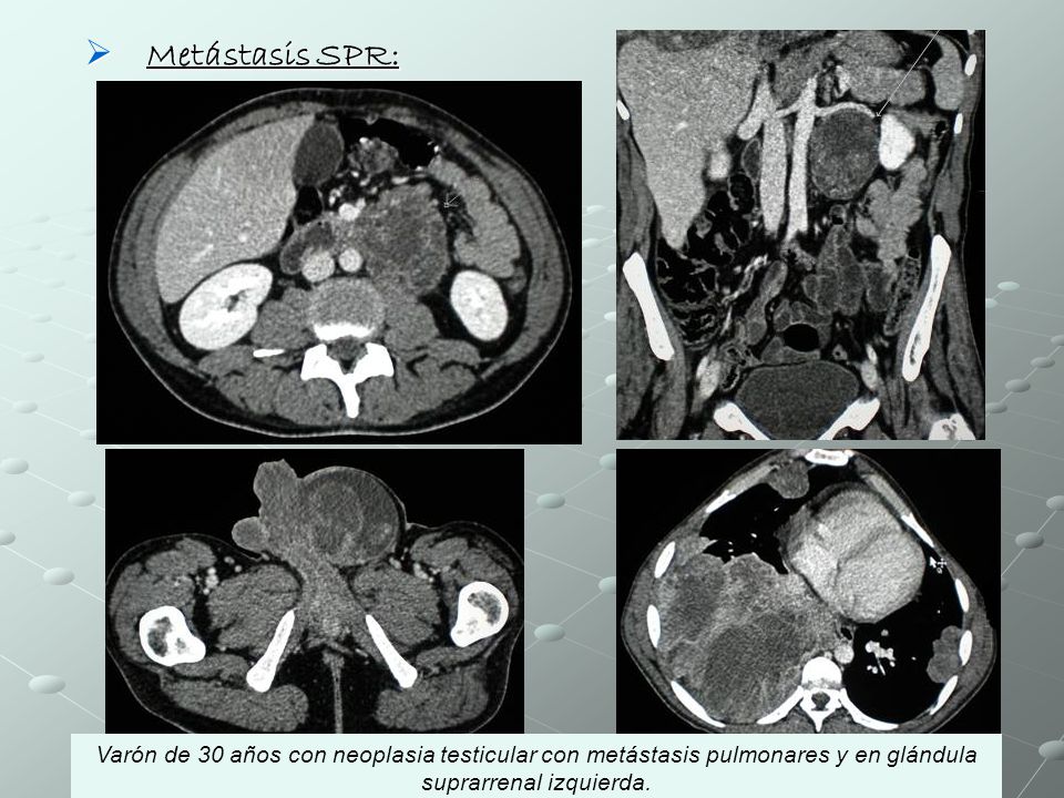 Metástasis SPR: Varón de 30 años con neoplasia testicular con metástasis pulmonares y en glándula suprarrenal izquierda.