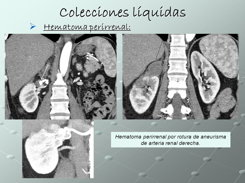 Hematoma perirrenal por rotura de aneurisma de arteria renal derecha.