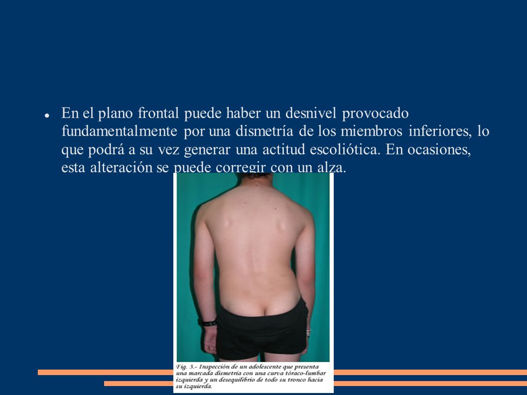 En el plano frontal puede haber un desnivel provocado fundamentalmente por una dismetría de los miembros inferiores, lo que podrá a su vez generar una actitud escoliótica.