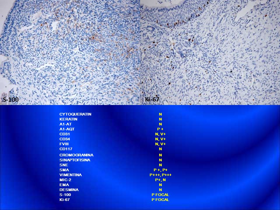 S-100 Ki-67 CYTOQUERATIN N KERATIN A1-AT A1-AQT P + CD31 N, V+ CD34