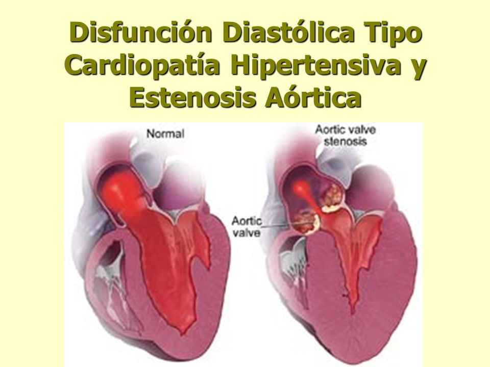 Disfunción Diastólica Tipo Cardiopatía Hipertensiva y Estenosis Aórtica