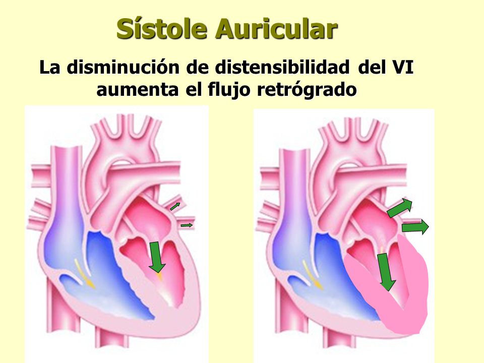 Sístole Auricular La disminución de distensibilidad del VI aumenta el flujo retrógrado