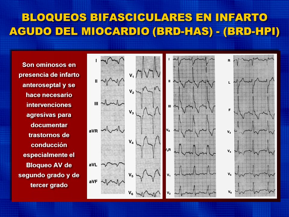 BLOQUEOS BIFASCICULARES EN INFARTO AGUDO DEL MIOCARDIO (BRD-HAS) - (BRD-HPI)