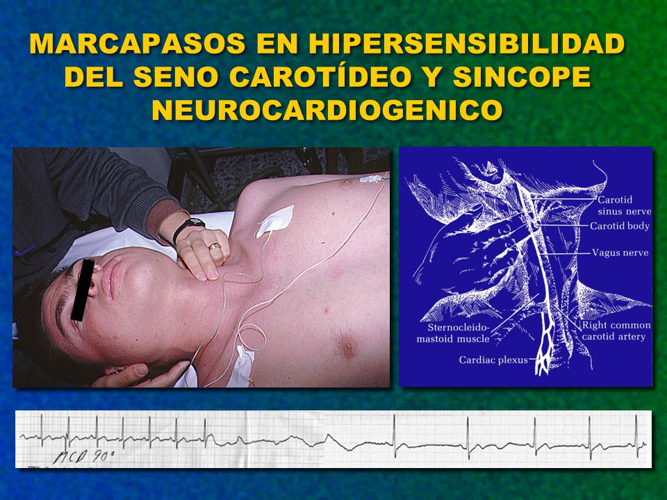 MARCAPASOS EN HIPERSENSIBILIDAD DEL SENO CAROTÍDEO Y SINCOPE NEUROCARDIOGENICO